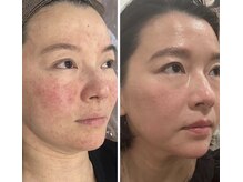 BBC 田園調布/スピダイヤで理想の素肌へ♪