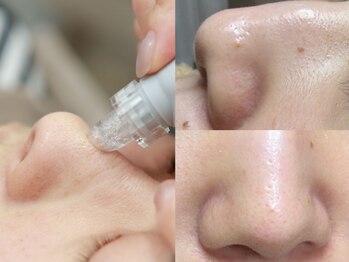 プルティティア(Pultitia)の写真/【毛穴洗浄プレミアム】機械とハンドの組み合わせで、最接近でも自信のある肌を目指しましょう♪