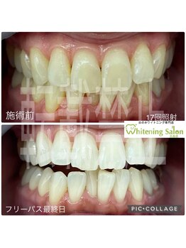 ホワイトニングサロン 広島店/【ホワイトニング17回照射】