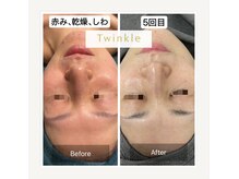 ティンクル(Twinkle)/赤み・乾燥・しわ