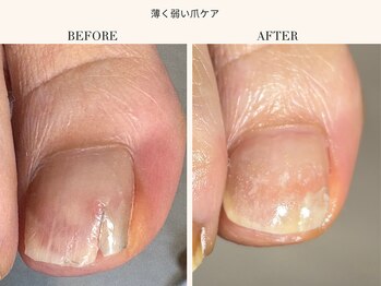 フット薄く弱い爪ケア