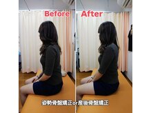 美藤鍼灸院/骨盤矯正のBeforeAfter
