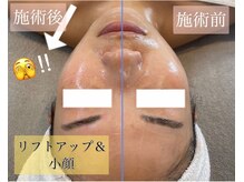 ジュエッテ(jouete)/大人気！小顔管理