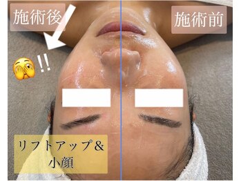 ジュエッテ(jouete)/大人気！小顔管理