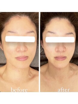 ジーニー(Genie)/歪み矯正はサービス