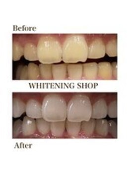 ホワイトニングショップ 新宿店/【ホワイトニング】BeforeAfter