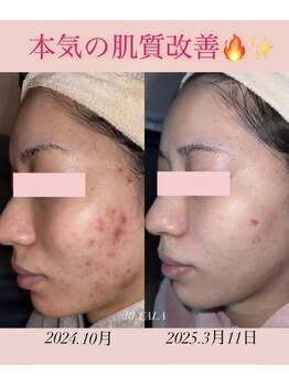 リファラ 光の森店(REFALA)/毛穴・ニキビケア専門REFALA