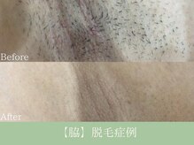エピア 岡崎店(Epia)/脇脱毛　4回の変化