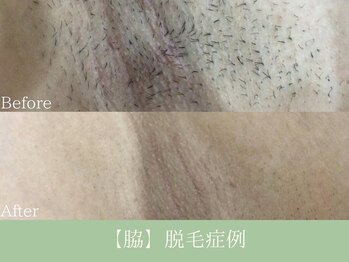 エピア 岡崎店(Epia)/脇脱毛　4回の変化