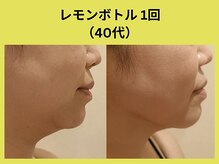 リンク 錦糸町店(Link)/レモンボトル1回