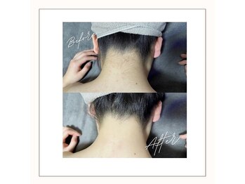 ラベニール(La Benir)/うなじ脱毛