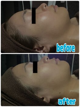 ラクラク(rakuraku)/リフトアップフェイシャル/30代