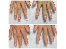 ミコ(.mico)の雰囲気(自爪育成、深爪、巻き爪、変形爪の補正や再生を行っております。)