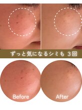 ココロ(COCORO)/シミケア機3台でアプローチ！