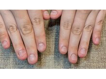 【深爪矯正・自爪育成専門店】Dream Nail 新宿/