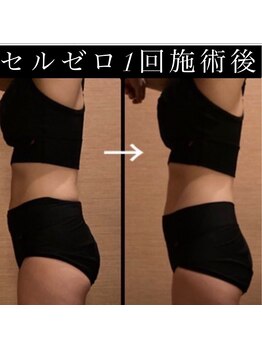 マイン イオンモール浜松市野店/大人気！セルライトゼロ！