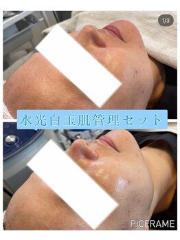 ジュエッテ(jouete)/圧倒的人気！水光白玉肌管理