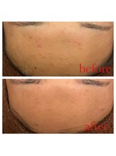 アクアプラス(AQUA+)/陶肌トリートメント20代女性