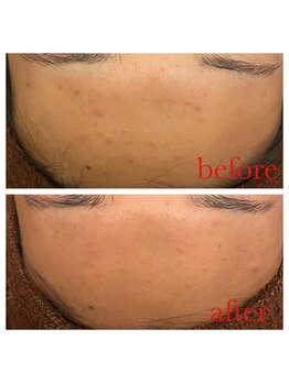 アクアプラス(AQUA+)/陶肌トリートメント20代女性