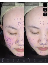 ジャスミン(Jasmin)/肌質診断機BA