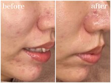 ホワイトアクア 天王寺本店(WHITE AQUA)/ララピールでニキビケア/天王寺