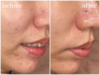 ホワイトアクア 天王寺本店(WHITE AQUA)/ララピールでニキビケア/天王寺