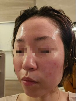 ビューティーメイクさくら/酒さ・赤ら顔改善