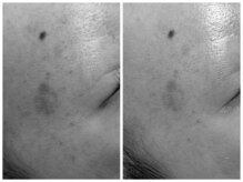 フェリス(FELIZ)/レチノールピール