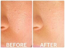 ハーブピーリング京橋の雰囲気（ターンオーバーを整える2bbiobeautyは長年のニキビケアに◎）