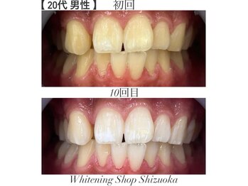 ホワイトニングショップ 静岡店/ホワイトニングBefore→After