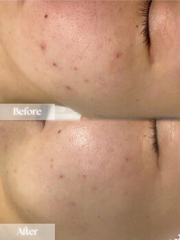 アップユー(UPU)/フォト ビフォーアフター