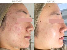 顔全体ニキビお悩みだったお客様。メイクも楽しめるように♪