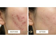 ルネル(Lunelle)/光フェイシャルでニキビ集中ケア