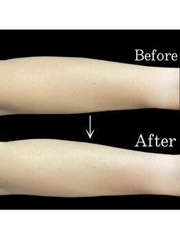 リブ(Lib)/脱毛に日焼け肌は危険!!