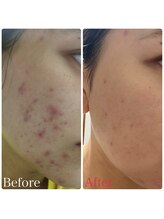 ビューティースタイリング 自由が丘店(beauty styling)/【美顔器パスリル】