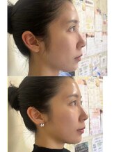 マホロバ(mahoroba)/ララピール×美容鍼（マホロバ）