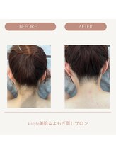 ケースタイル(k.style)/全身脱毛