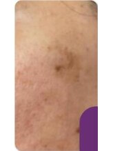 お顔そりローズマリー/ハーブピーリング