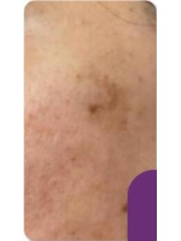 お顔そりローズマリー/ハーブピーリング