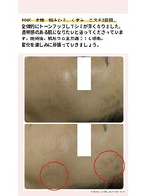 マインドール/2回のエステでシミが変化！