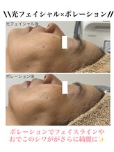 ココネイル 板山店(coco nail)/光フェイシャル×ポレーション