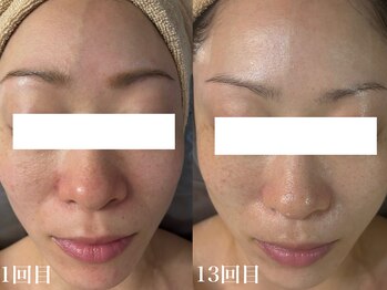 ホワイトアクア 北千住店(WHITE AQUA)/ララピール/透明感/艶肌