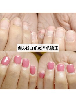 マニエネイル(mani e nail)/剥離爪を保護しながら、自爪育成
