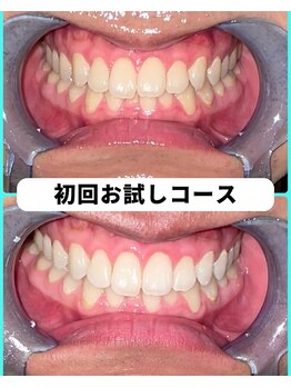 ホワイトニングビューティー 吉祥寺店/ホワイトニング 初来店
