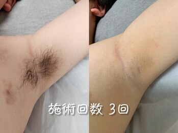 シェリー(CHERIE)/脇は効果を実感しやすい