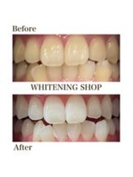 ホワイトニングショップ 新宿店/【ホワイトニング】BeforeAfter
