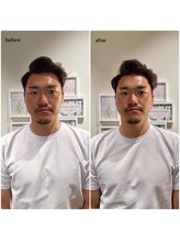 アネラ 本町(ANERA)/小顔矯正&毛穴洗浄BeforeAfter