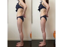 レナトゥス 銀座(Renatus)/BeforeAfter【美脚/東京/銀座】