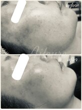 エルール トータルビューティ(Aileure total beauty)/ララピール　肌質改善