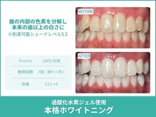 クレア(Crea)/【歯のホワイトニング症例写真】